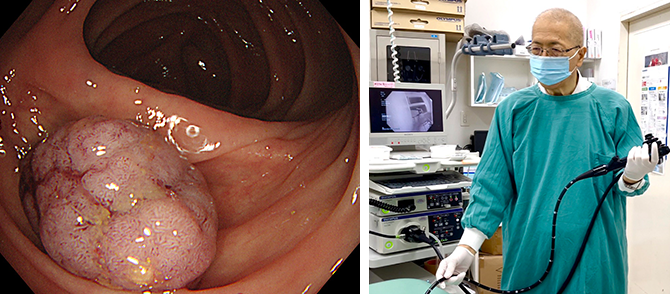 大腸カメラについて